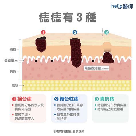 生黑痣|痣形成的原因？痣長毛、痣變多變大是痣病變？5招判。